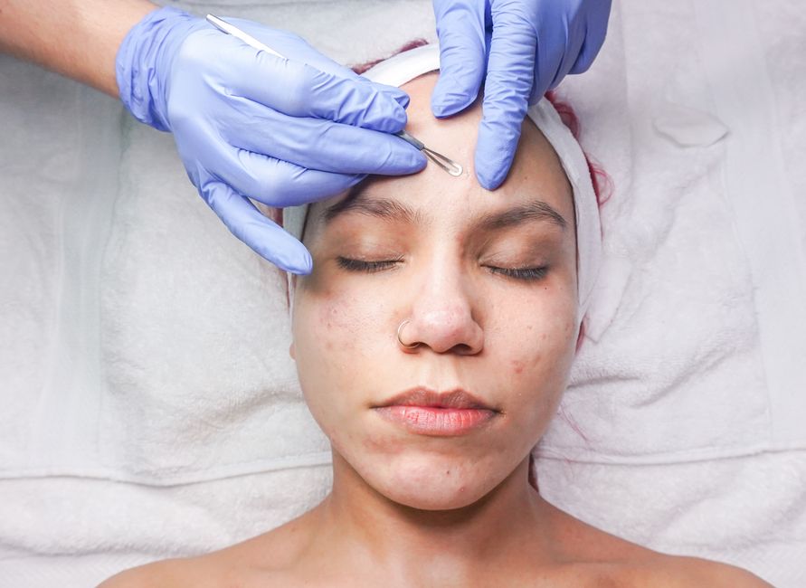Acne Facial